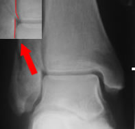 ankle lateral injury