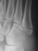tuberosity fracture