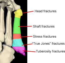 5th metatarsal fracture classification