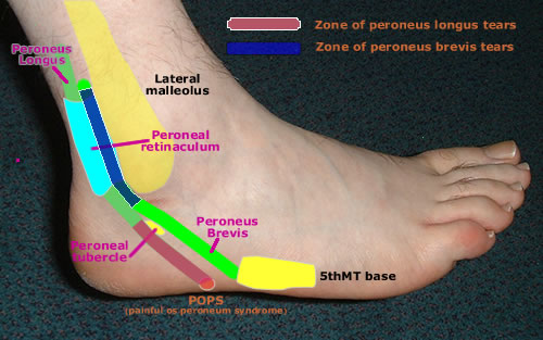 peroneal tendon pathology